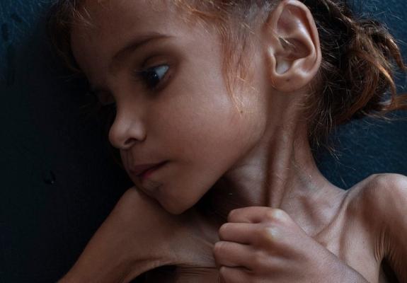 Πέθανε το κοριτσάκι που έγινε σύμβολο της λιμοκτονίας