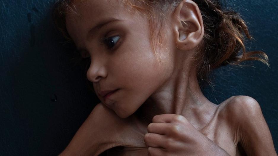 Πέθανε το κοριτσάκι που έγινε σύμβολο της λιμοκτονίας
